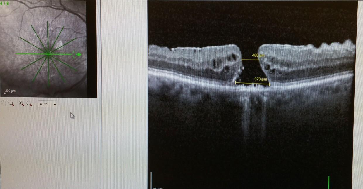 macular-hole-with-erm-BEFORE.jpg